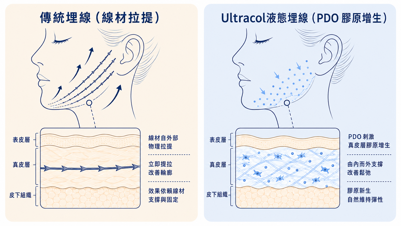 什麼是 Ultracol液態埋線?