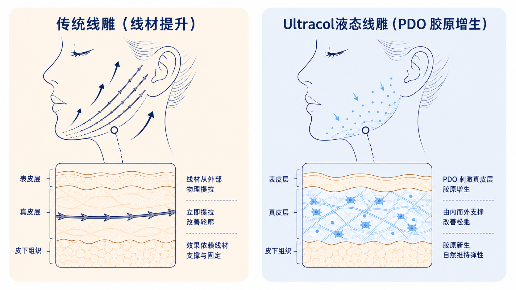 什么是Ultracol液态线雕?