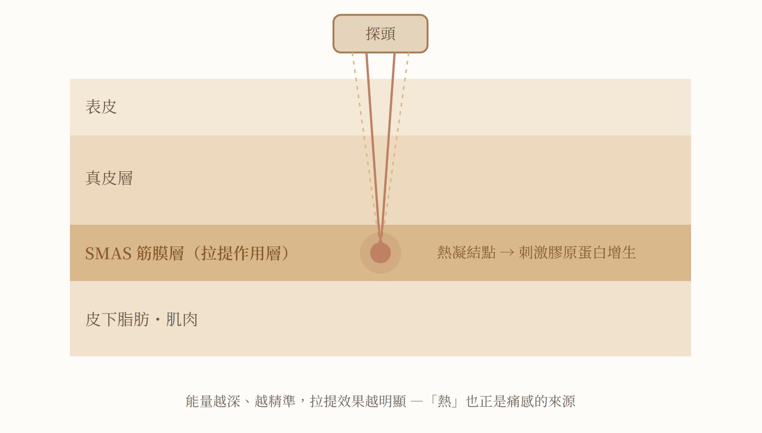 音波能量聚焦於深層 SMAS 筋膜層的示意