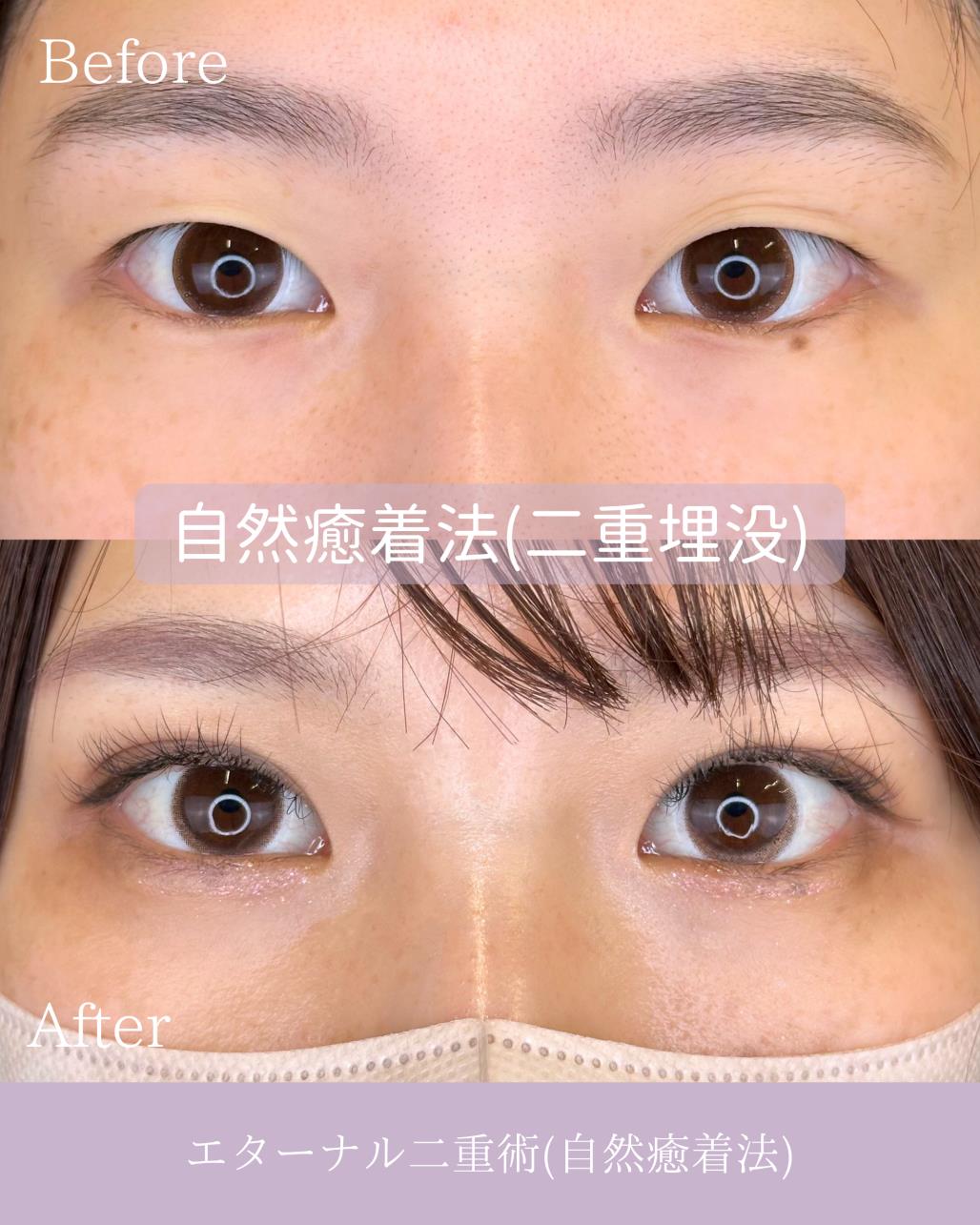 双眼皮手术