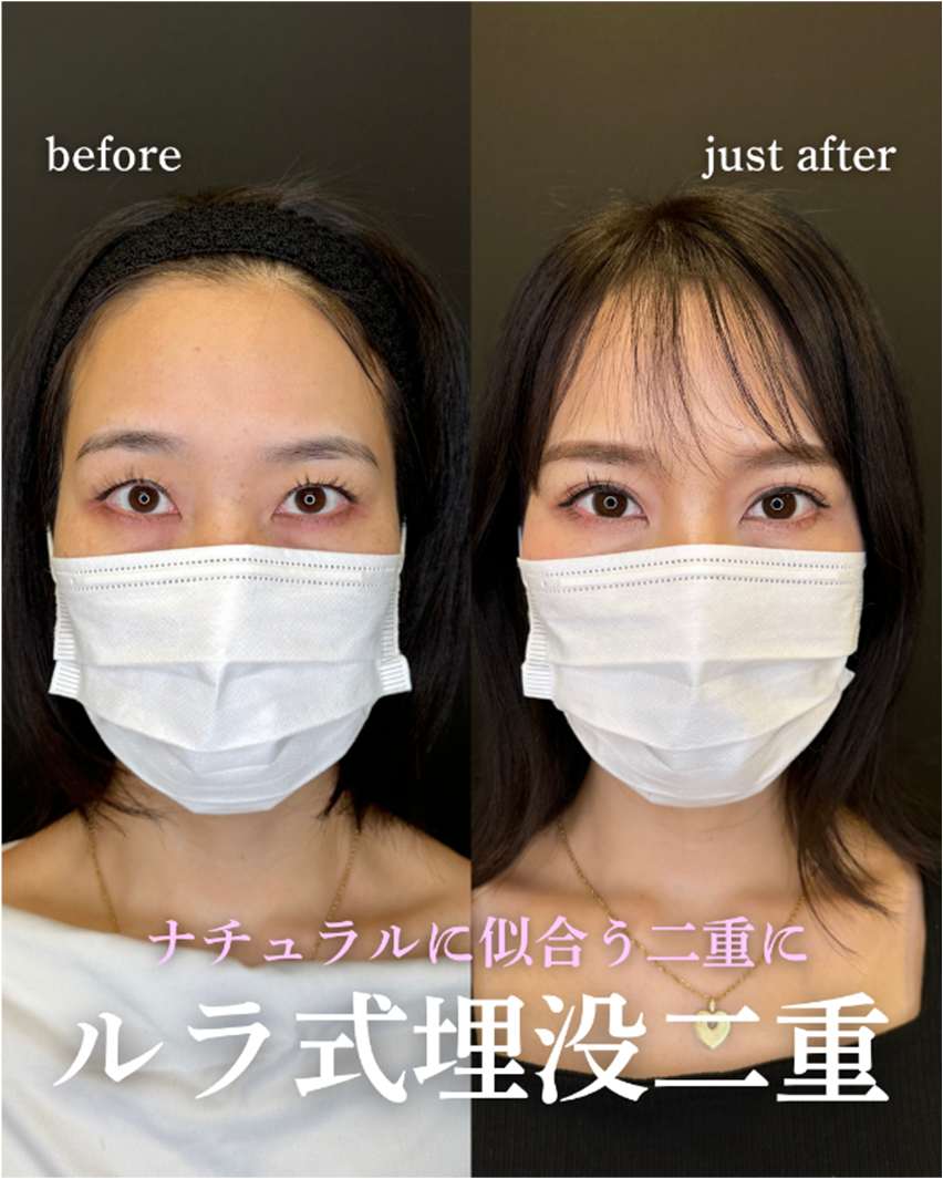 双眼皮手术