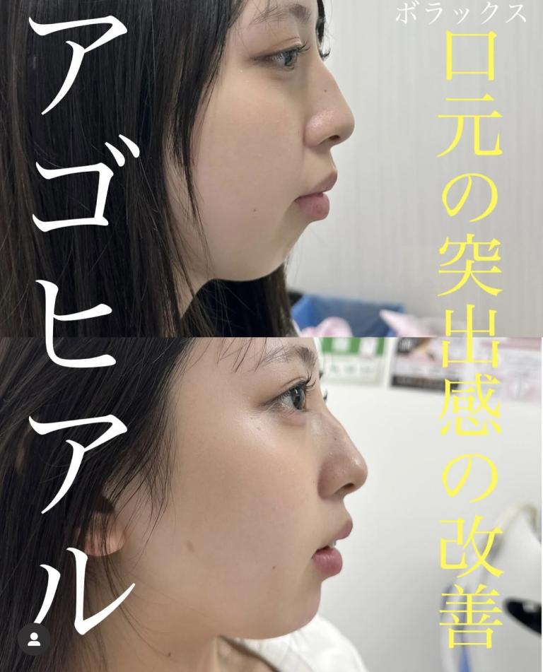 玻尿酸填充