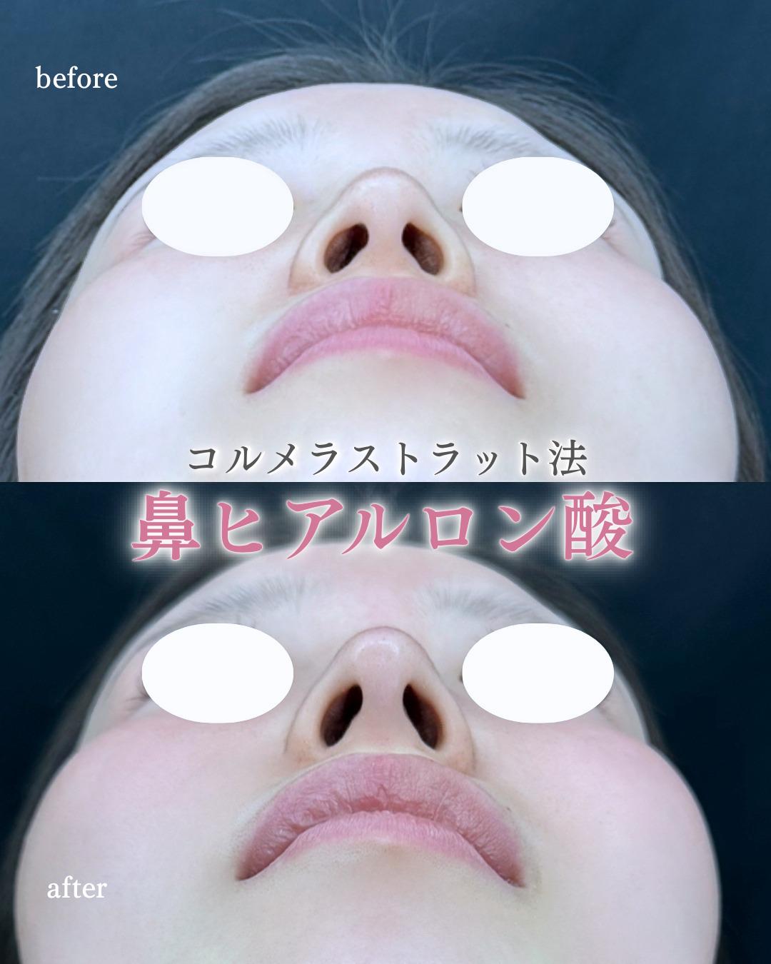 玻尿酸填充
