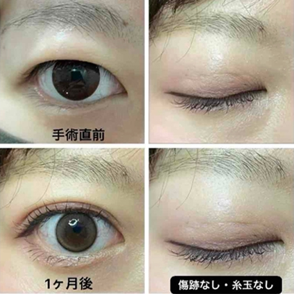 双眼皮手术