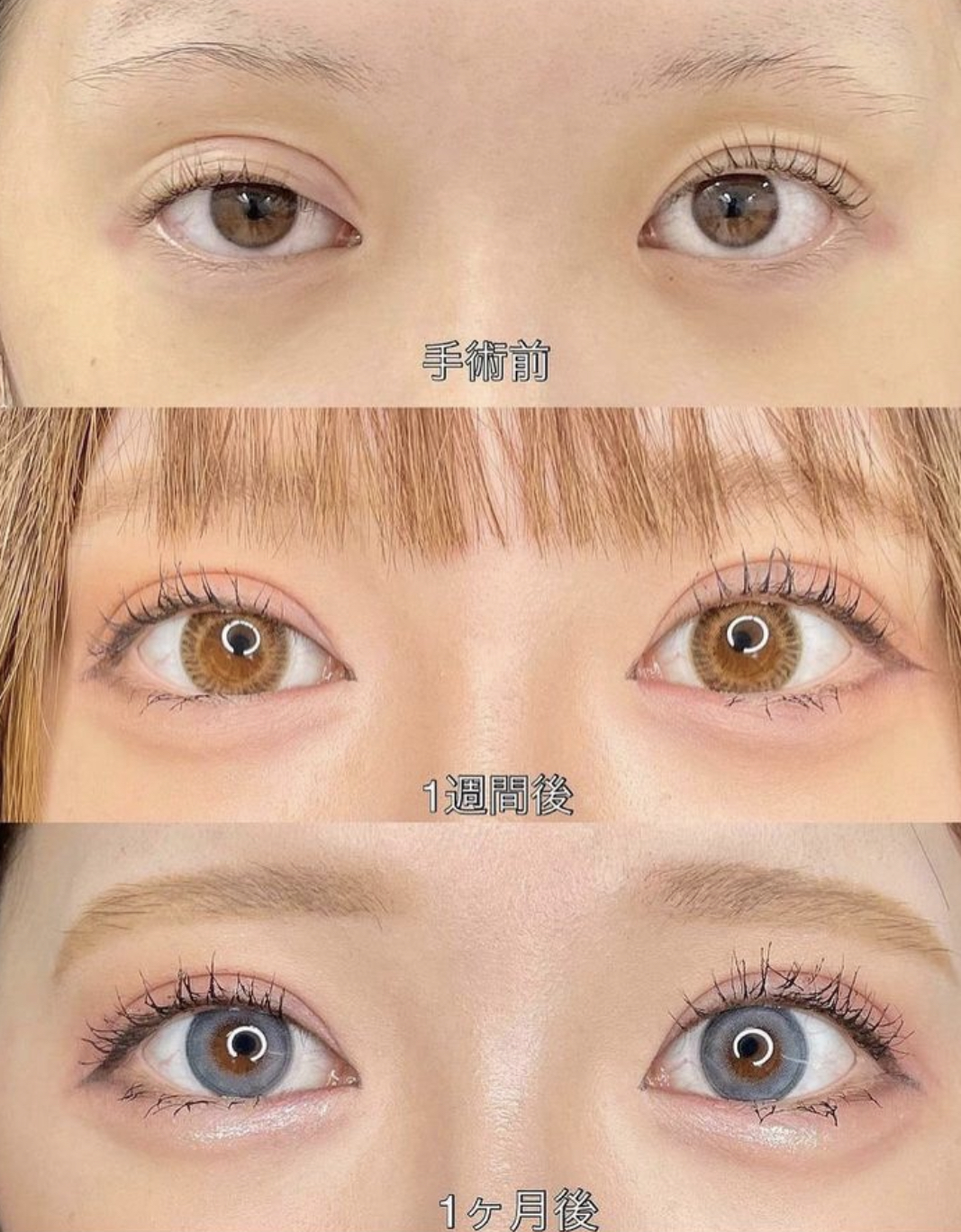 双眼皮手术