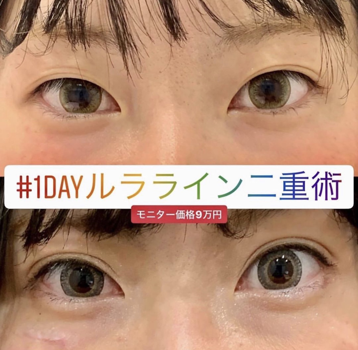 双眼皮手术