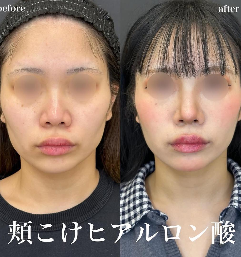 咬肌瘦脸针