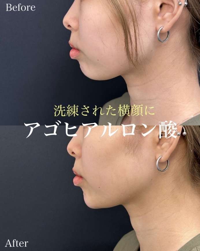 玻尿酸填充
