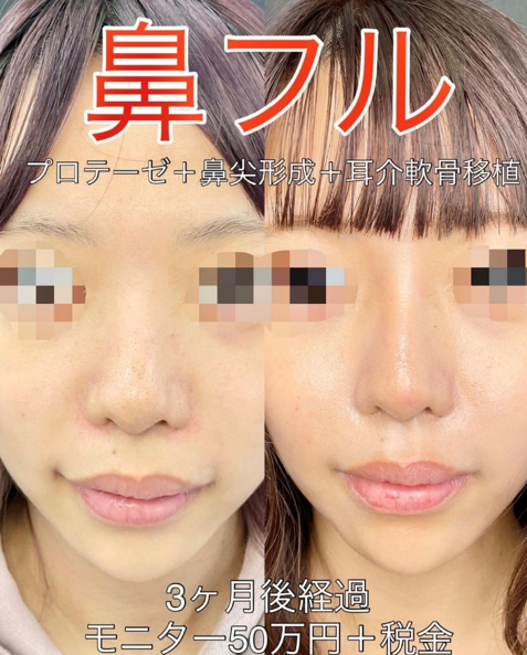 鼻综合整形 + 鼻梁整形 - 硅胶假体 + 鼻尖整形 - 切开法