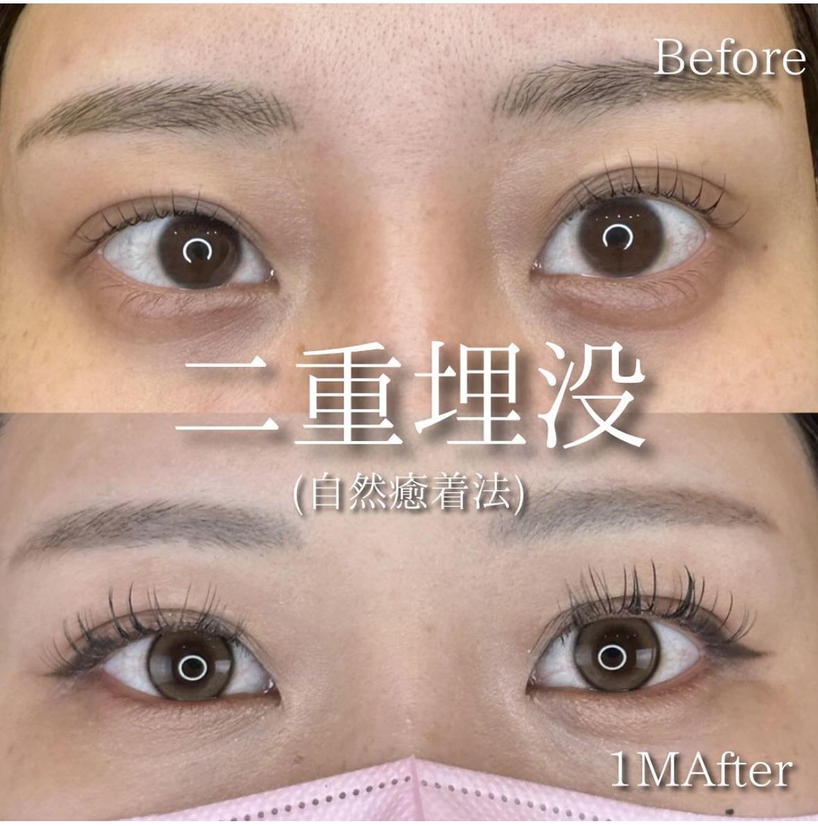 双眼皮手术