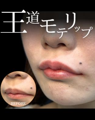 玻尿酸填充