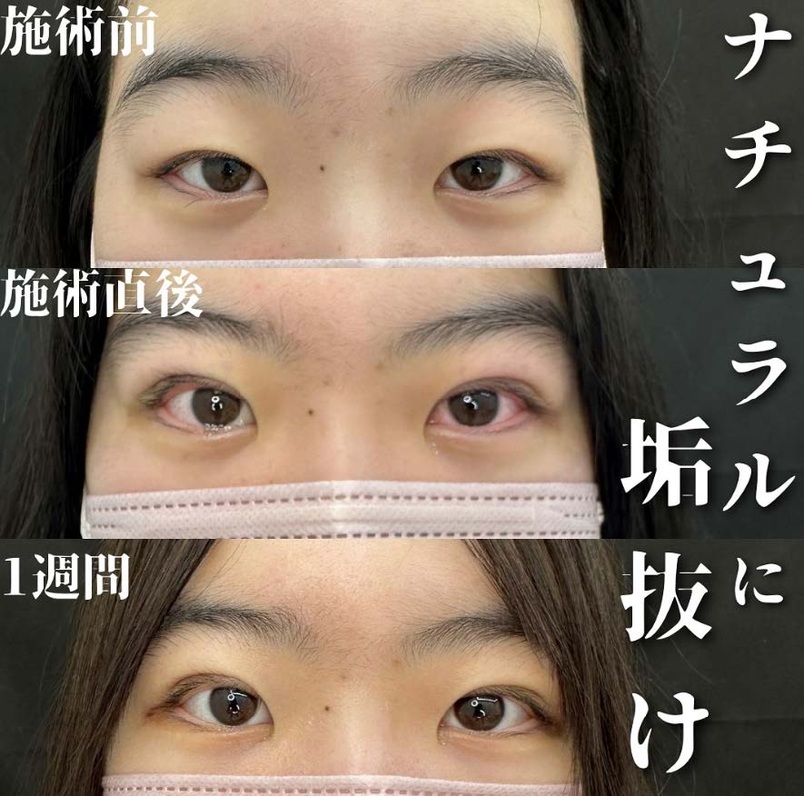 双眼皮手术