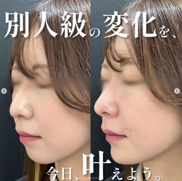 玻尿酸填充