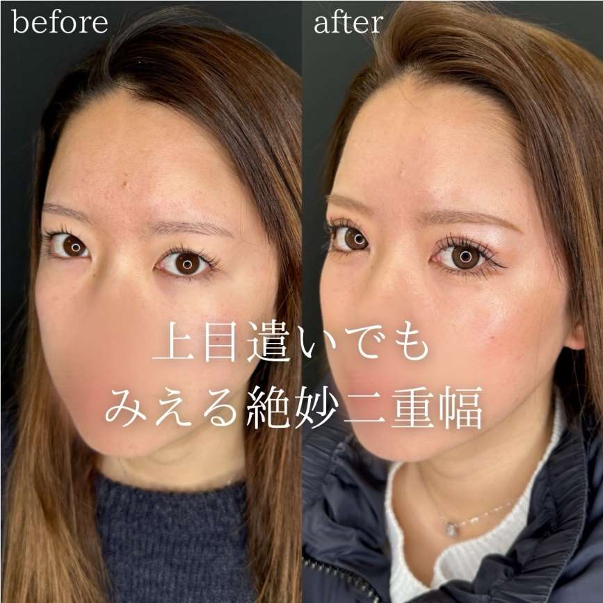 双眼皮手术