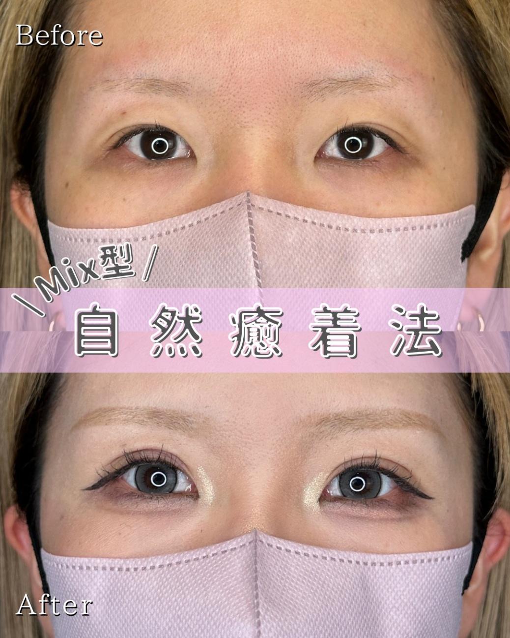 双眼皮手术