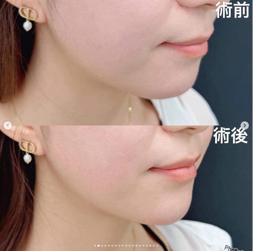 玻尿酸填充