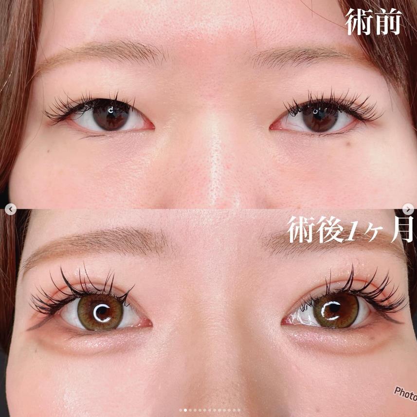 双眼皮手术
