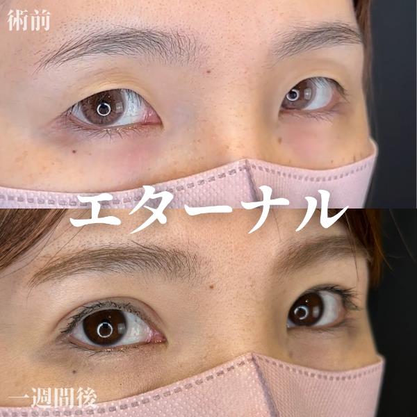 双眼皮手术