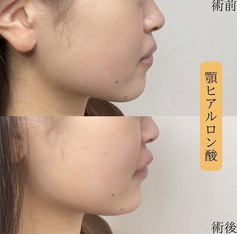 玻尿酸填充
