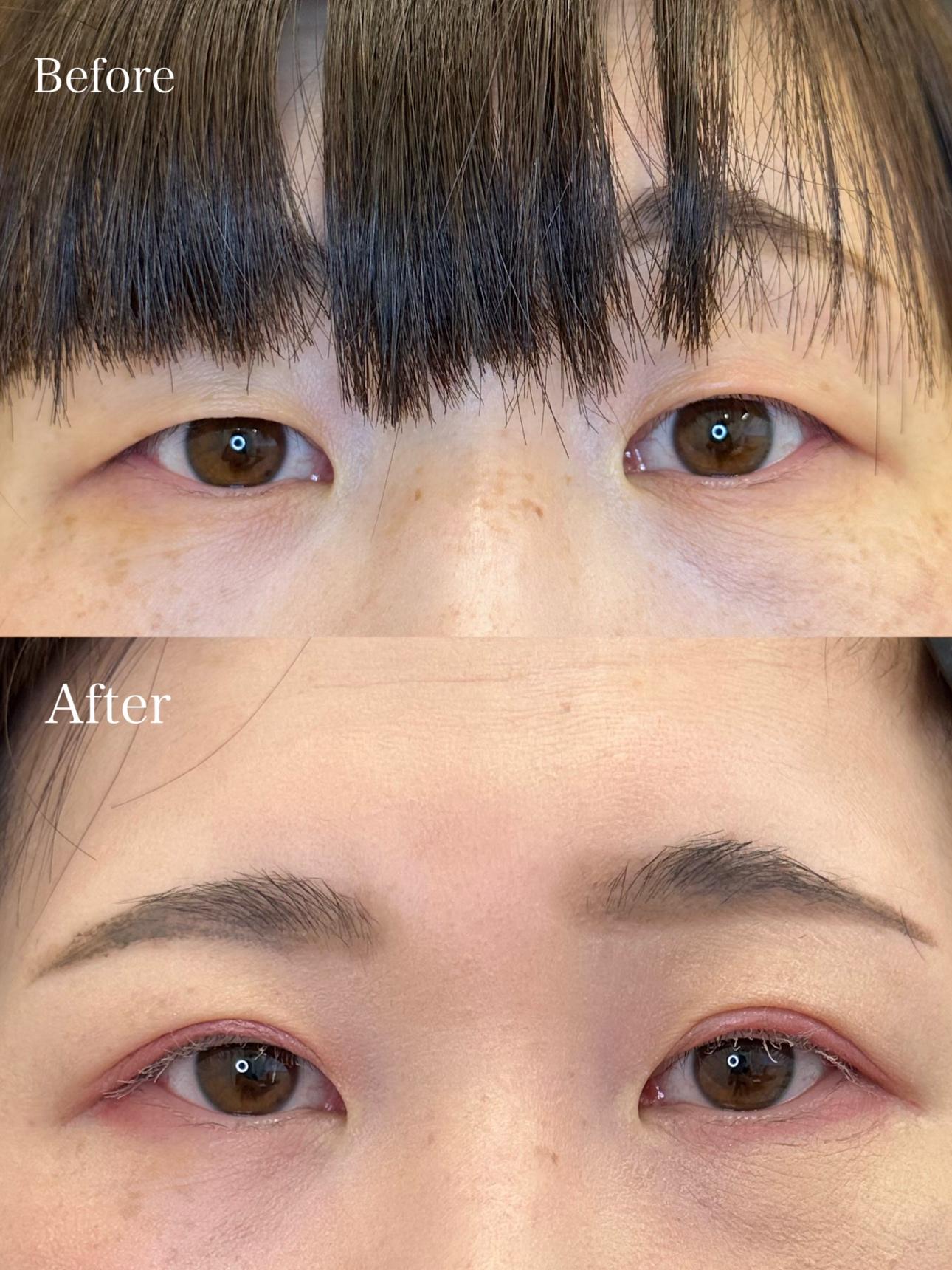 双眼皮手术
