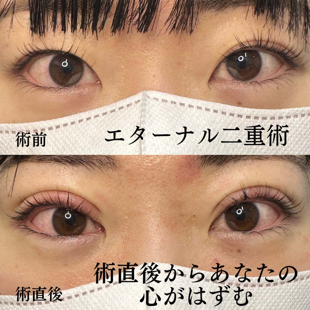 双眼皮手术