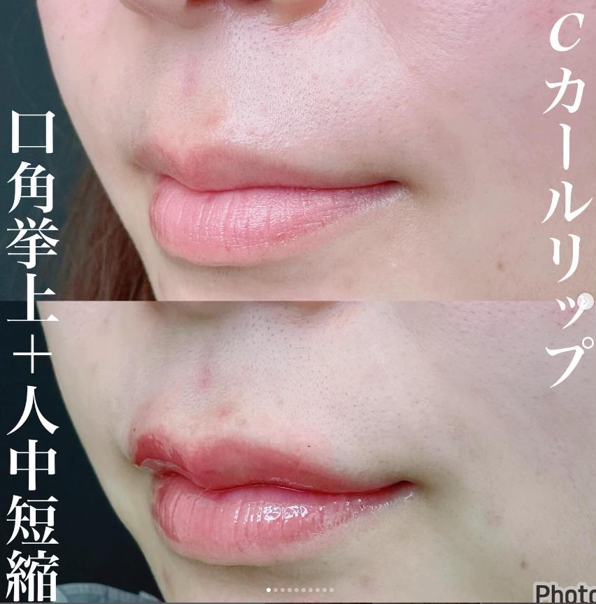 玻尿酸填充