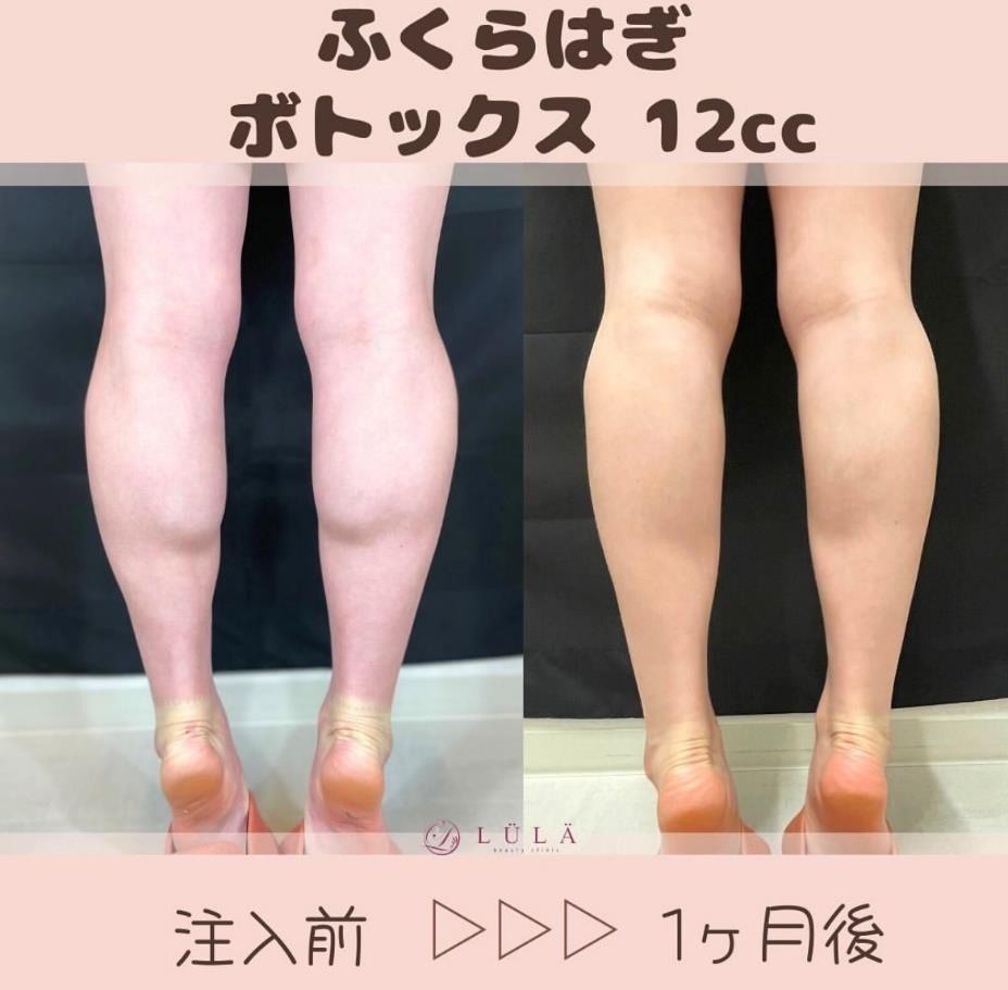 瘦小腿针/瘦大腿针