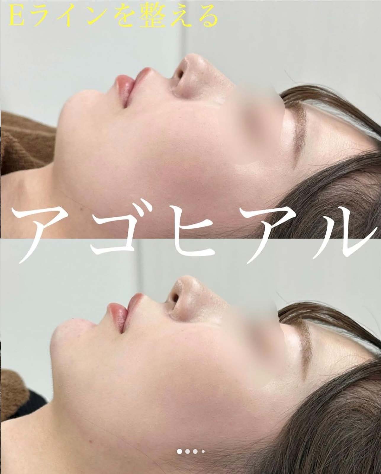 玻尿酸填充