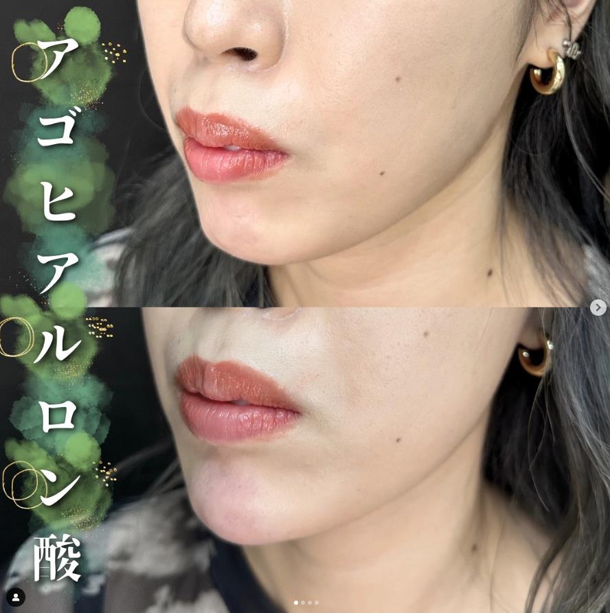 玻尿酸填充