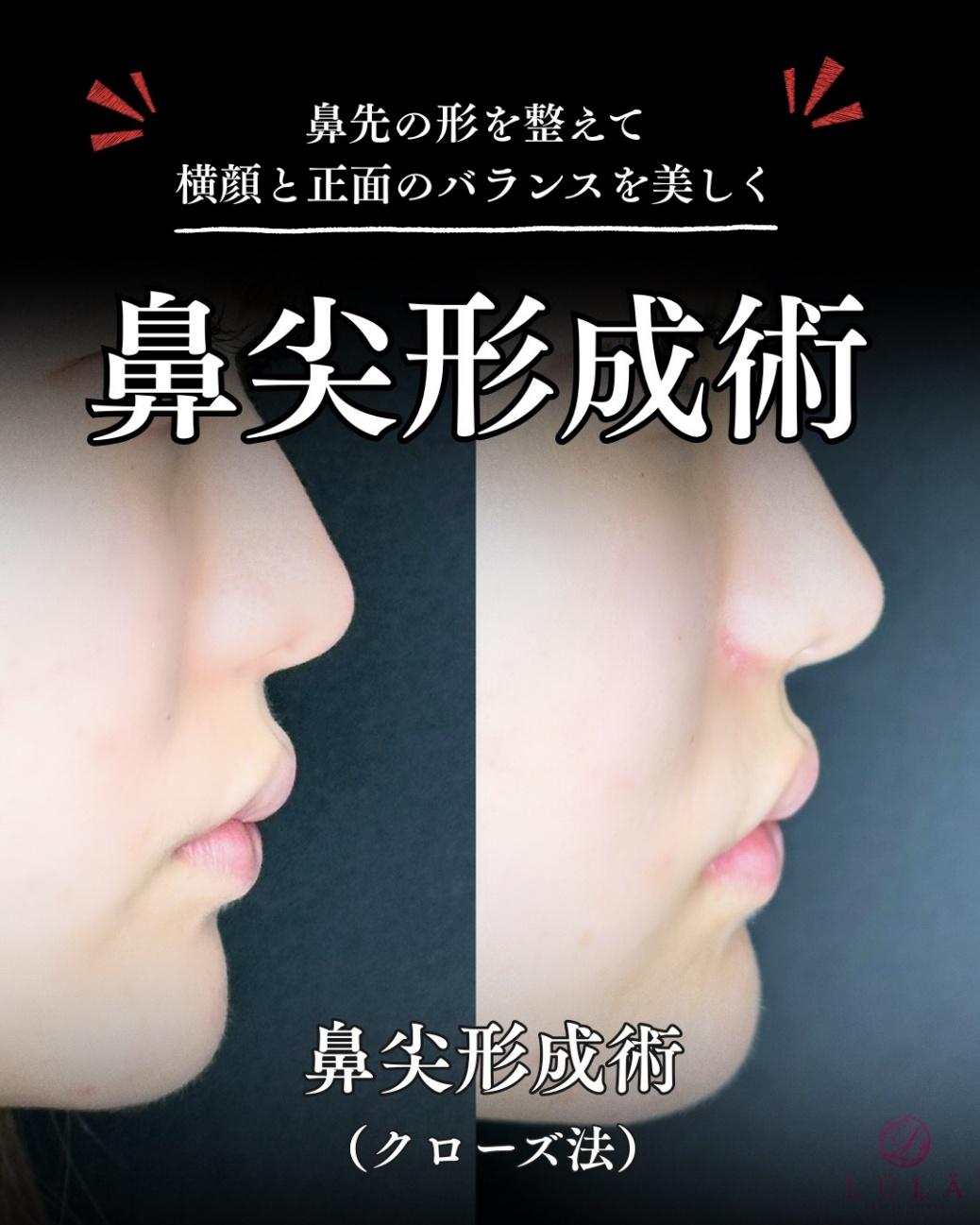 鼻综合整形 + 鼻尖整形 - 切开法