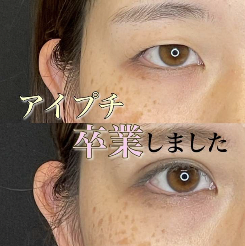 双眼皮手术