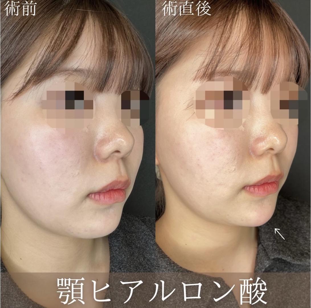 玻尿酸填充