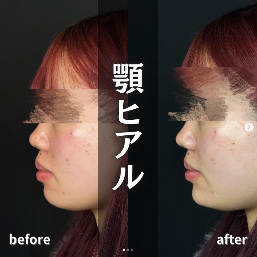 玻尿酸填充