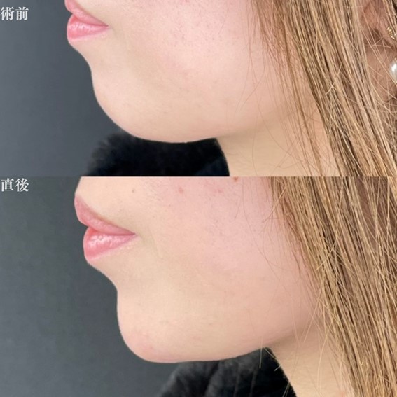 玻尿酸填充