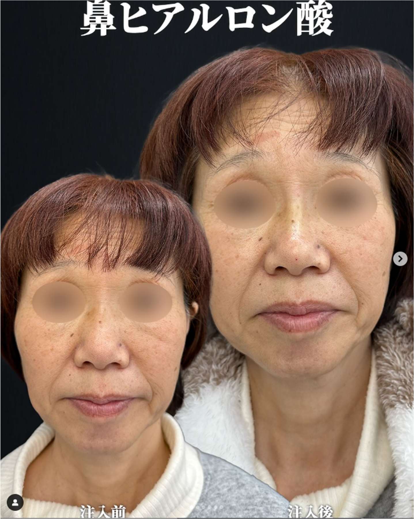 玻尿酸填充