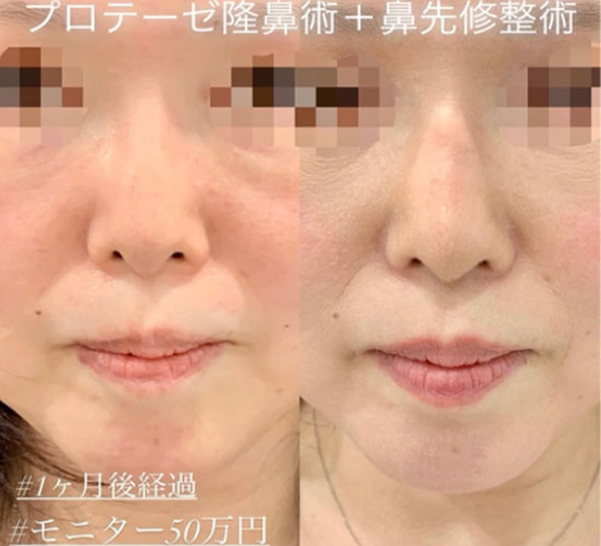 鼻综合整形 + 鼻梁整形 - 硅胶假体