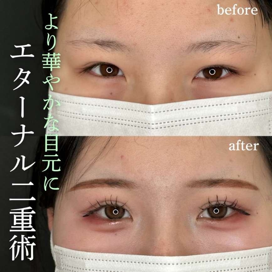 双眼皮手术