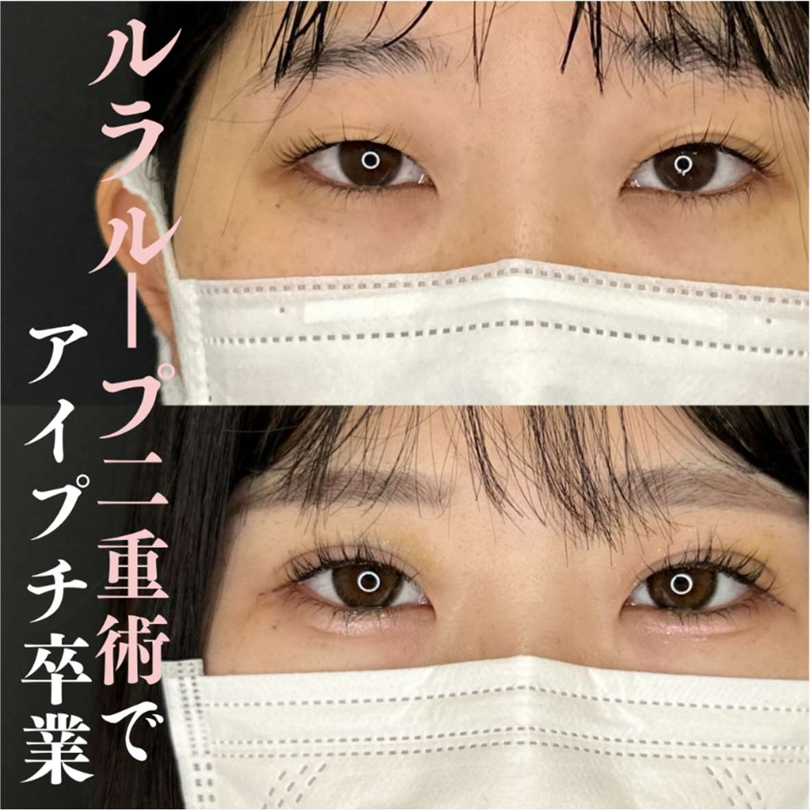 双眼皮手术