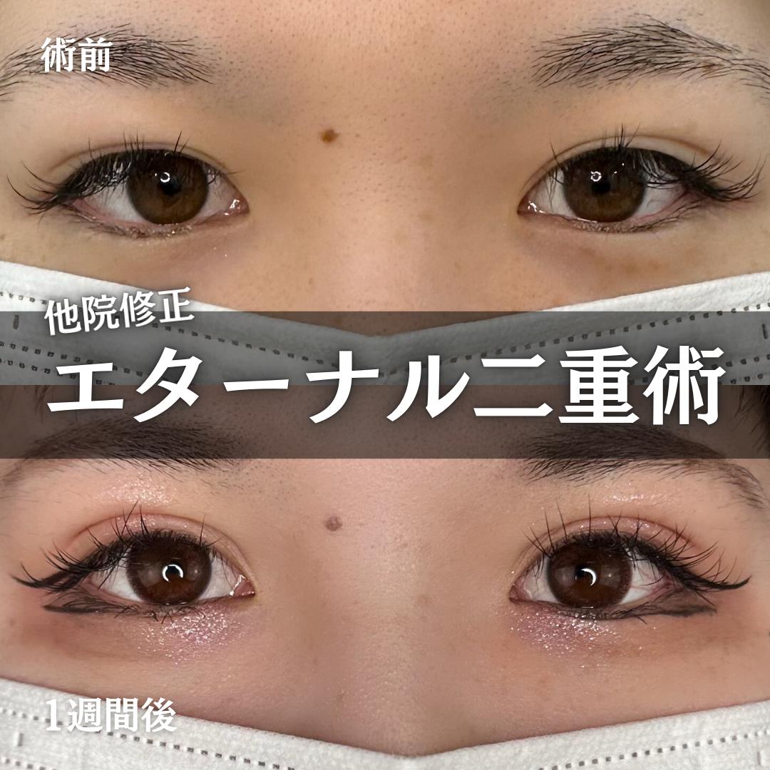 双眼皮手术