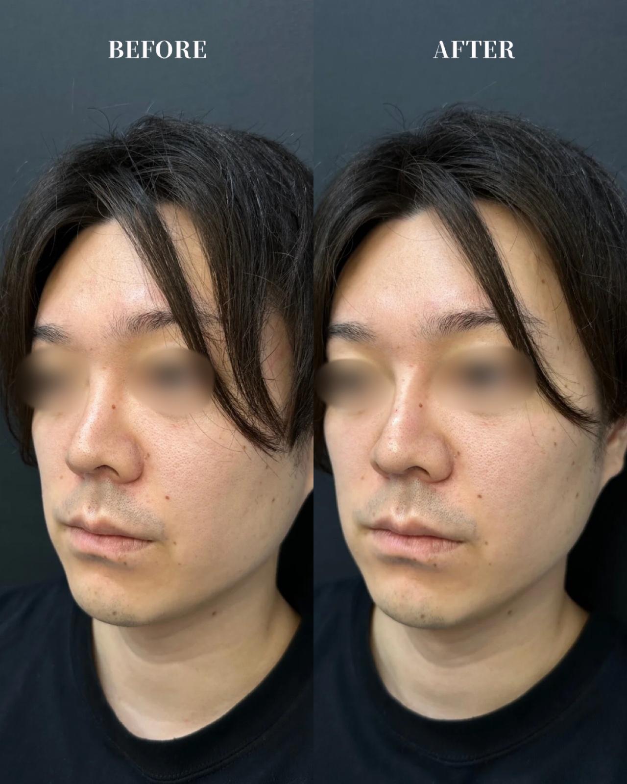 玻尿酸填充