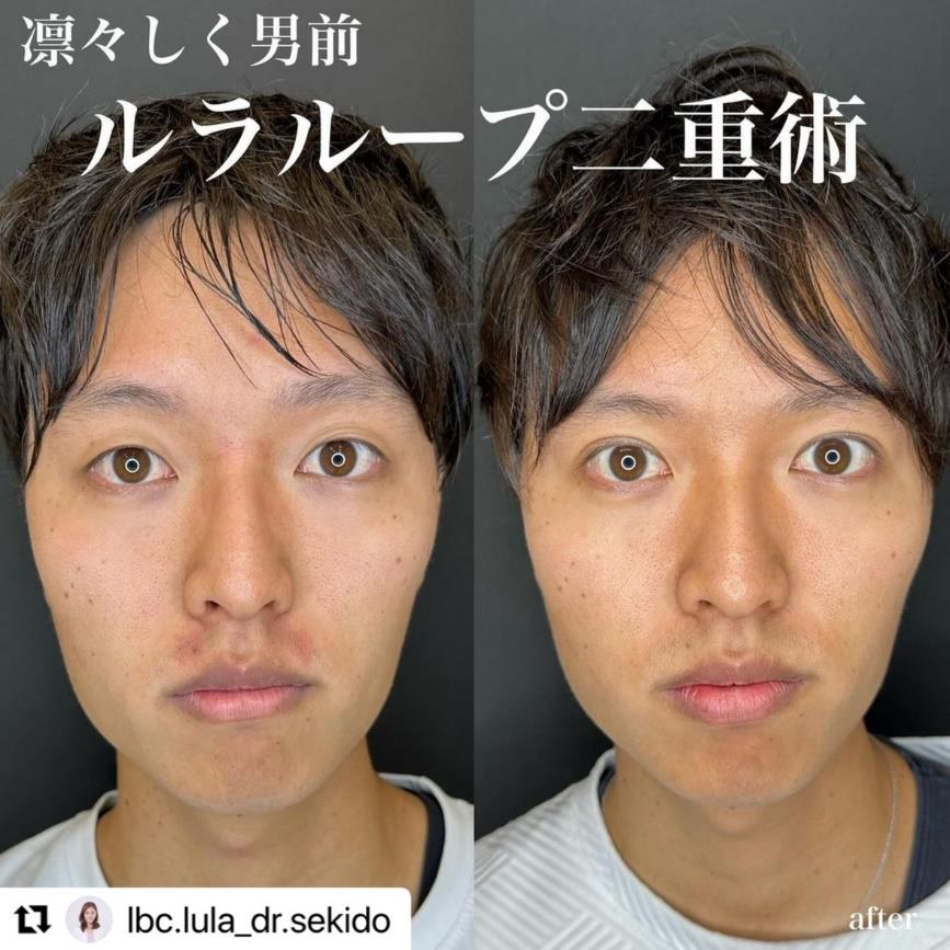 双眼皮手术