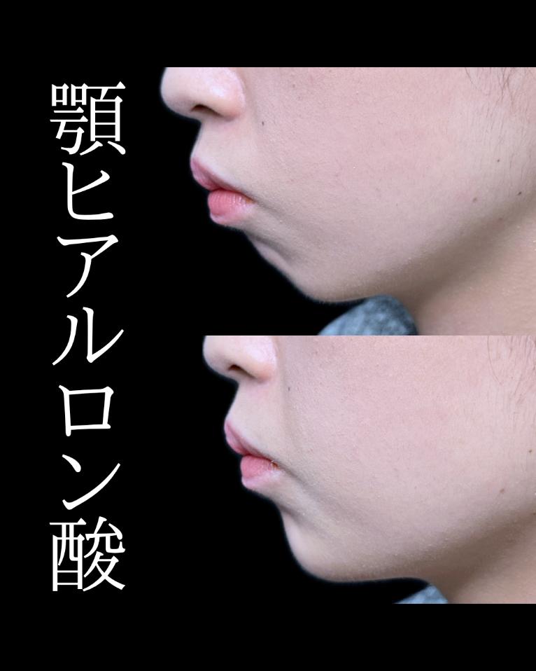 玻尿酸填充