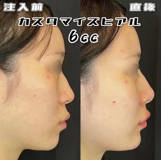 玻尿酸填充
