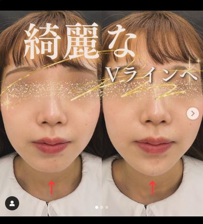 玻尿酸填充
