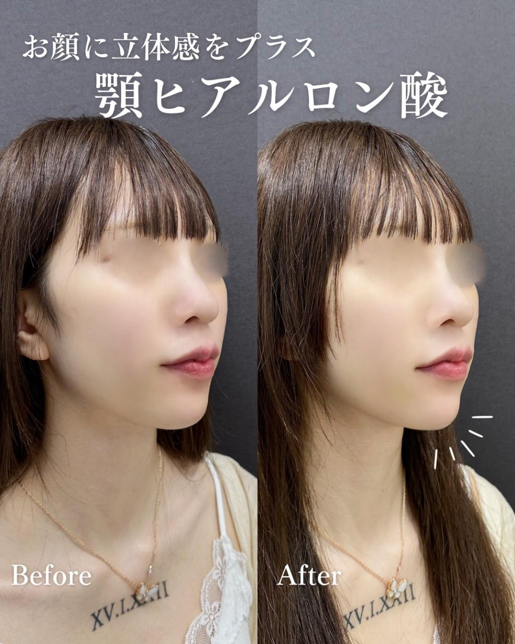 玻尿酸填充