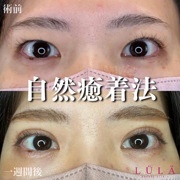 双眼皮手术