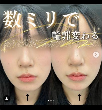 玻尿酸填充