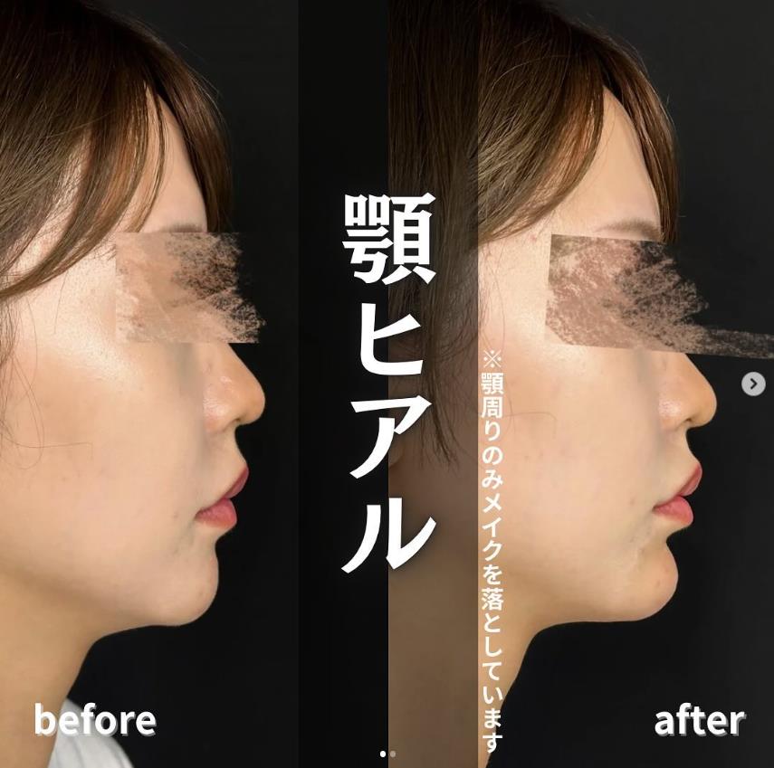 玻尿酸填充