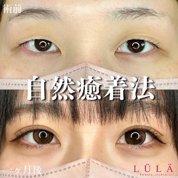 双眼皮手术