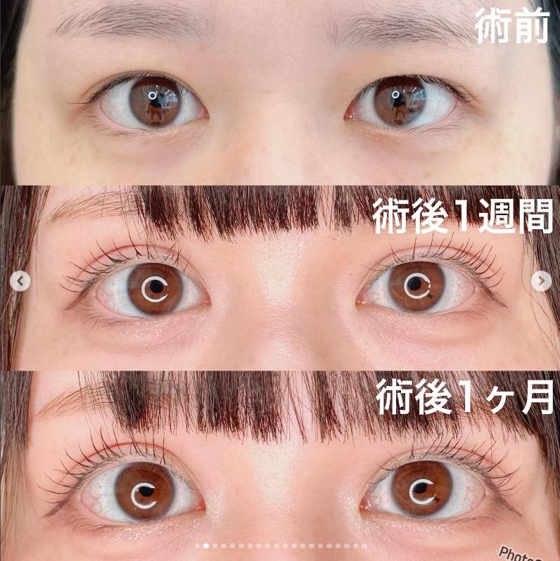 双眼皮手术